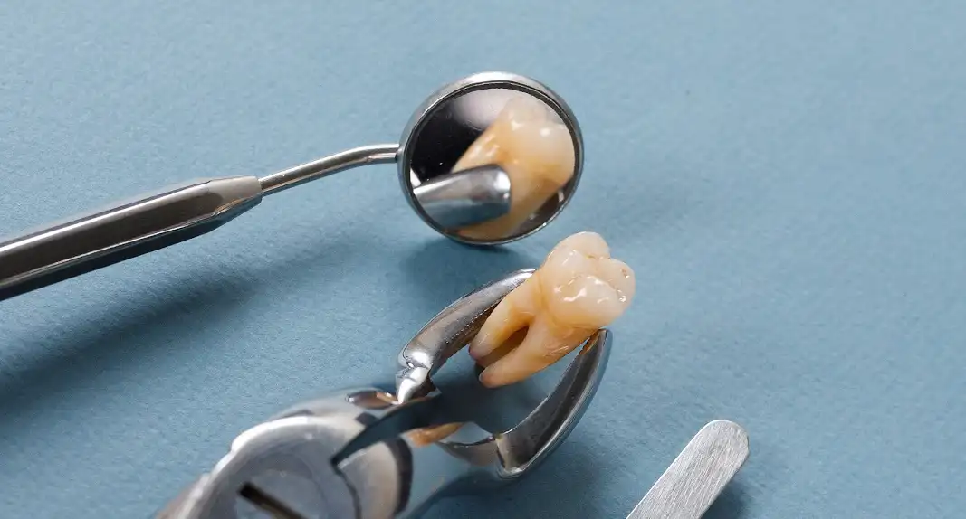 Что такое ретинированный зуб? Отвечает стоматолог Руссдент.