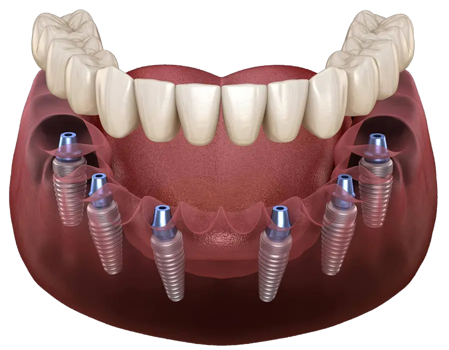 Технология имплантации зубов ALL-ON-6