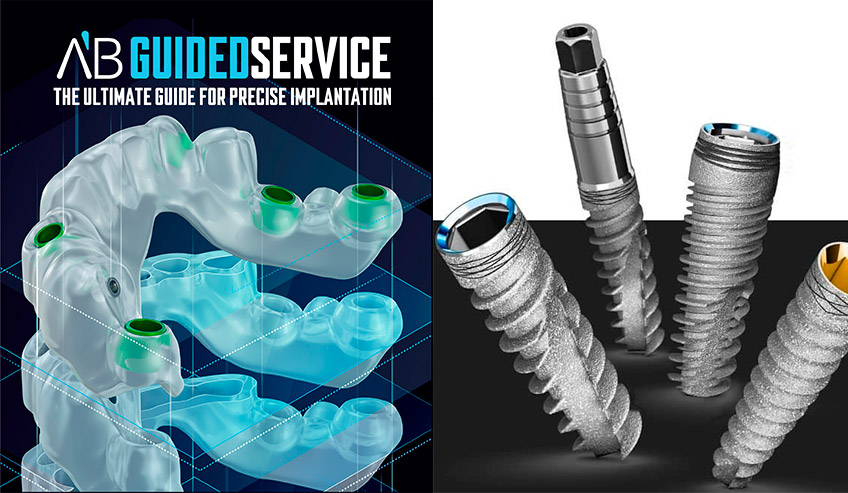 Система имплантатов A.B. Dental Devices