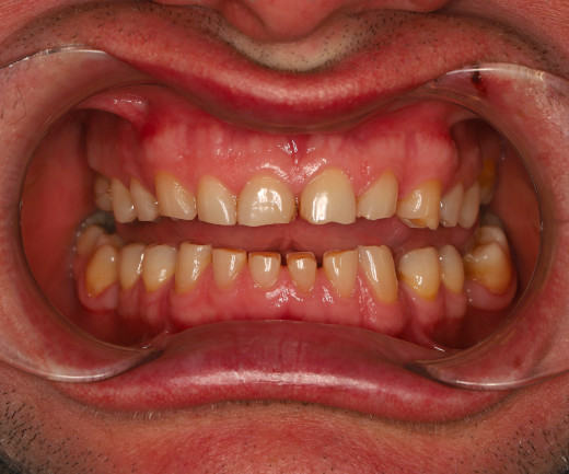 Диагностика стираемости зубов