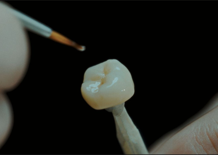 Установка виниров