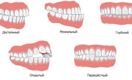 Нарушение прикуса легкой степени в вертикальной плоскости