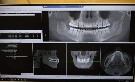 Глубокий прикус с сагиттальной щелью