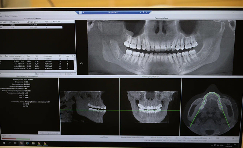 Глубокий прикус с сагиттальной щелью