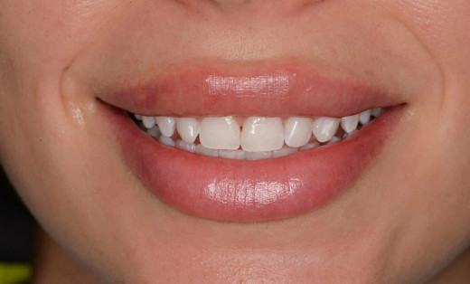 Отбеливание зубов: что нужно знать об этом?