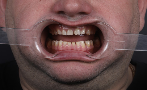 Стираемость зубов, последствия