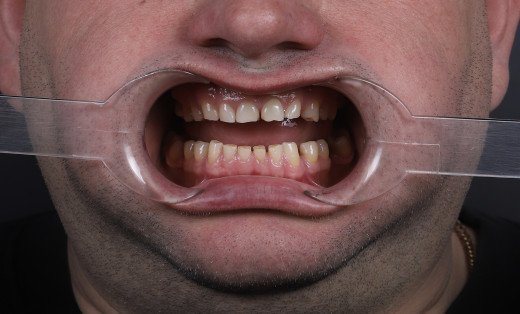 Стираемость зубов, последствия