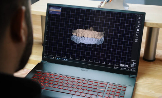 Глубокая резцовая дизокклюзия